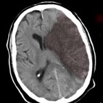 Síntomas comunes previos a un infarto cerebral