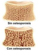 ¿Cómo se puede detectar la osteoporosis?