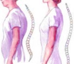 Consecuencias de caminar jorobado